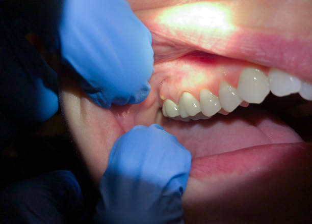 Best Emergency Denture Repair in Evadale, TX